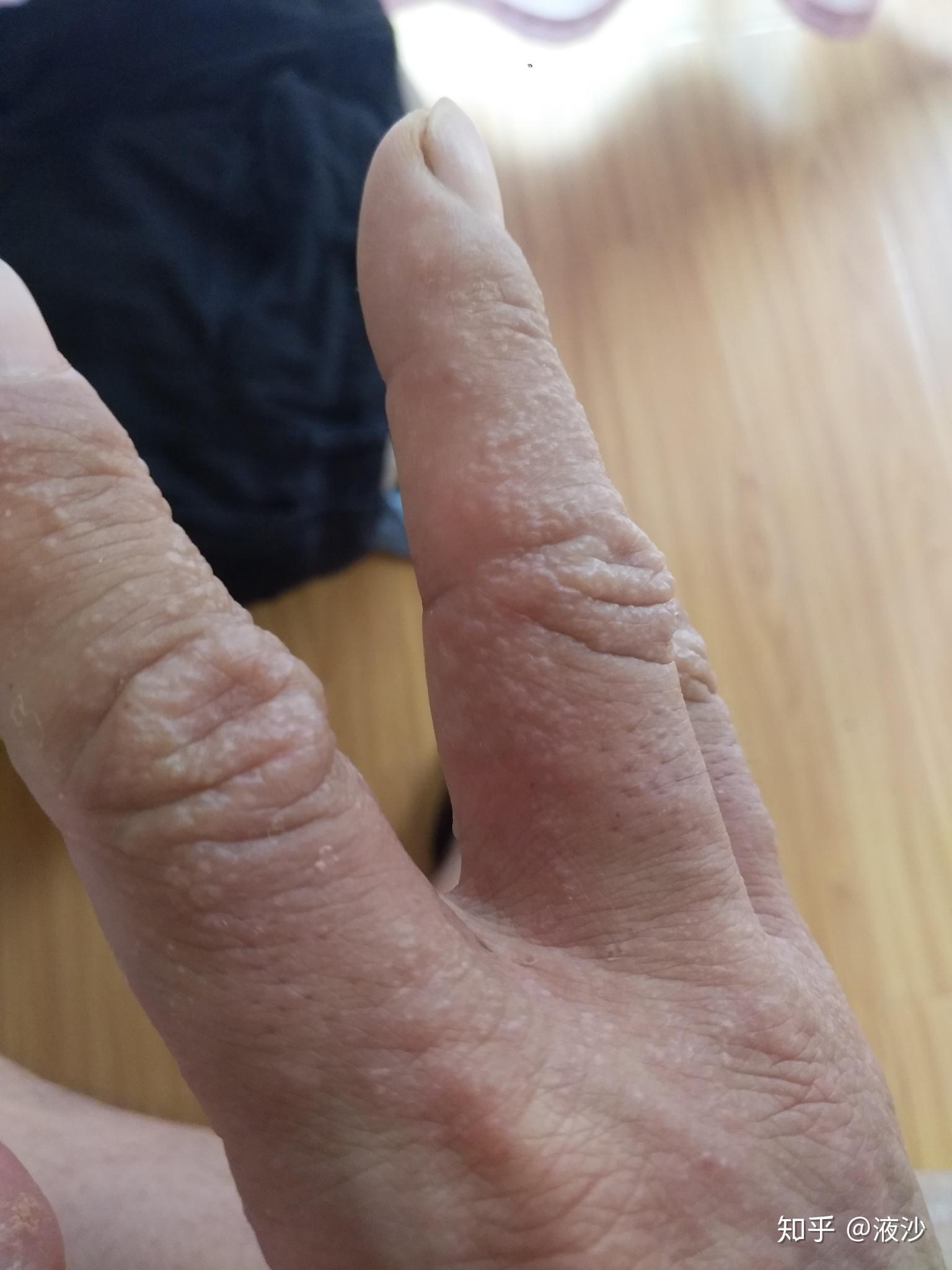 每年春天手上都会长类似水泡但比水泡小很多的泡泡微微有点痒然后会