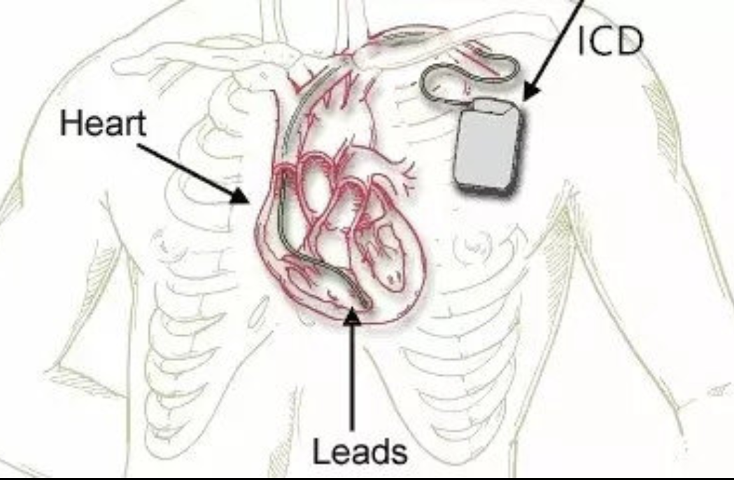 年纪轻轻的女孩子患上中老年人才常见的心脏疾病(特别是冠心病,心梗等