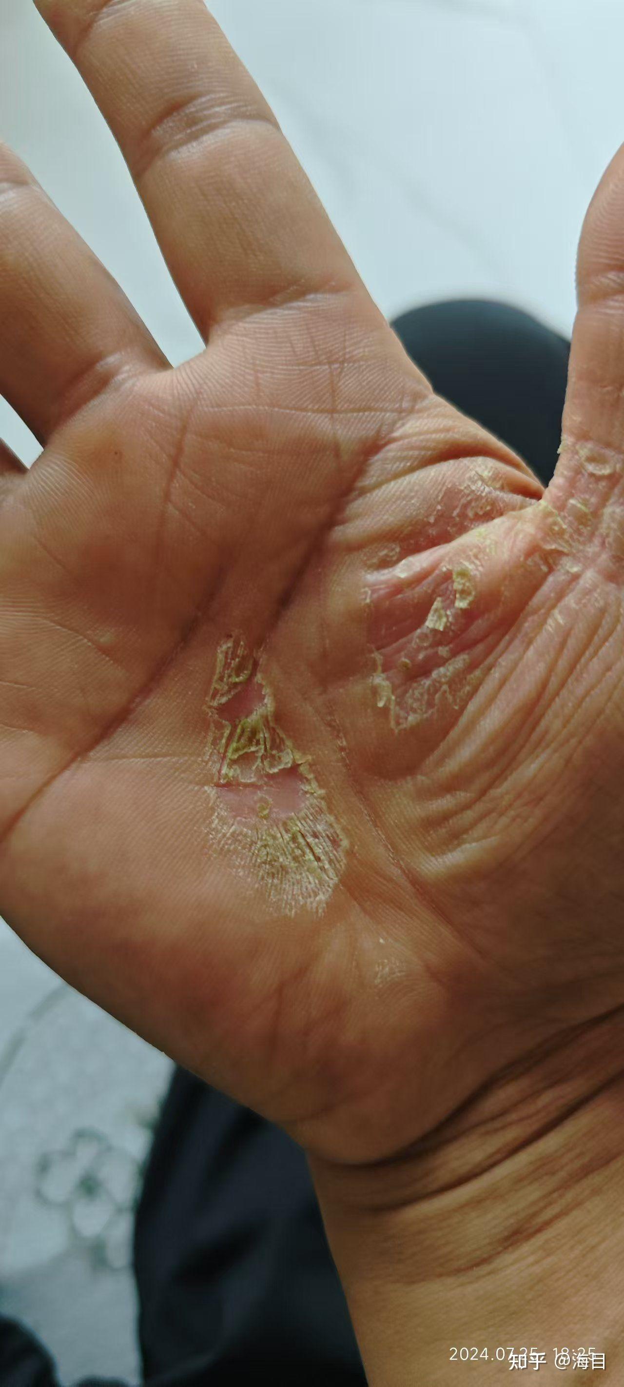 手心皲裂性湿疹,手掌裂口