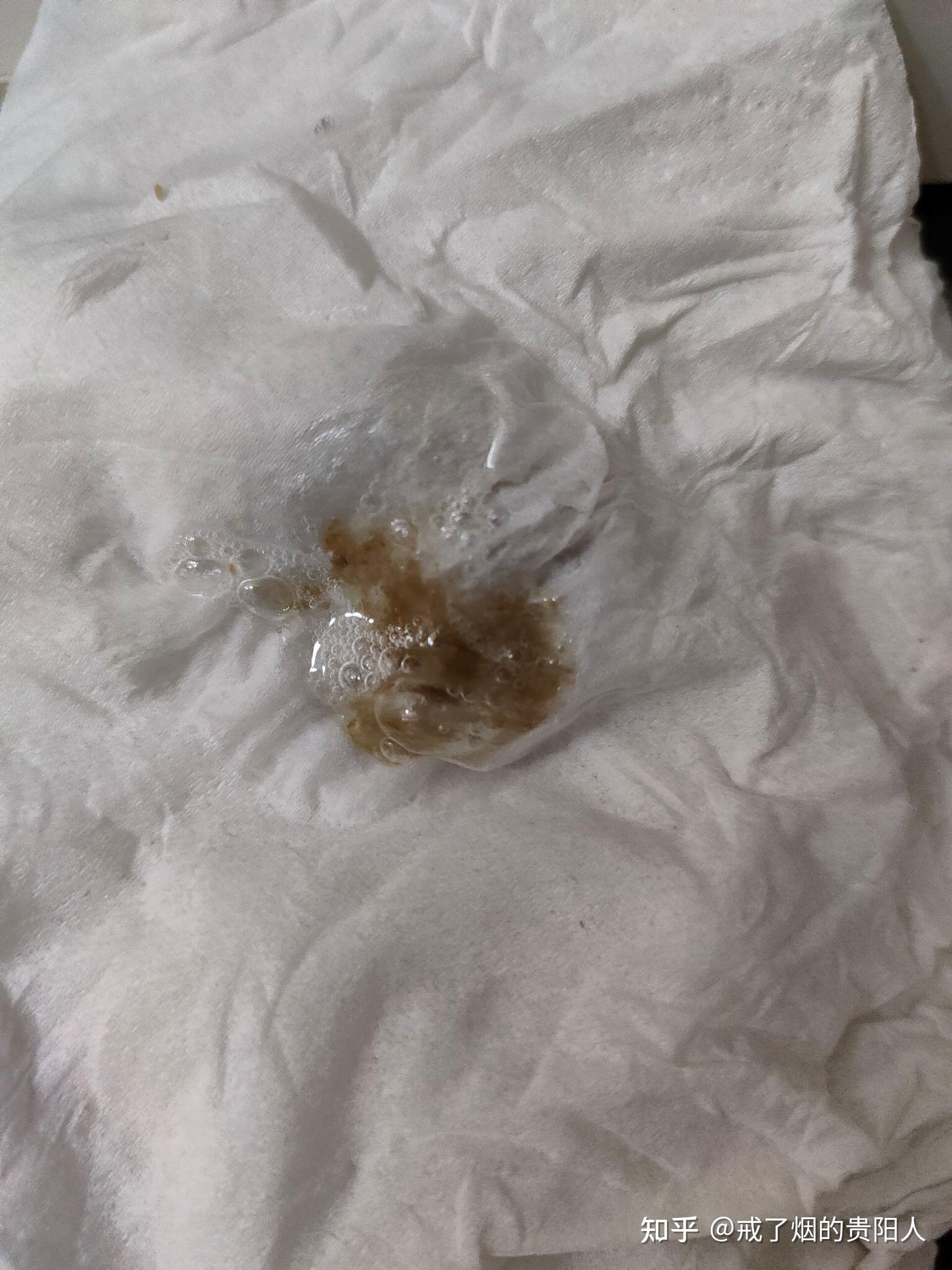 戒烟后吐出来的黑痰是什么物质