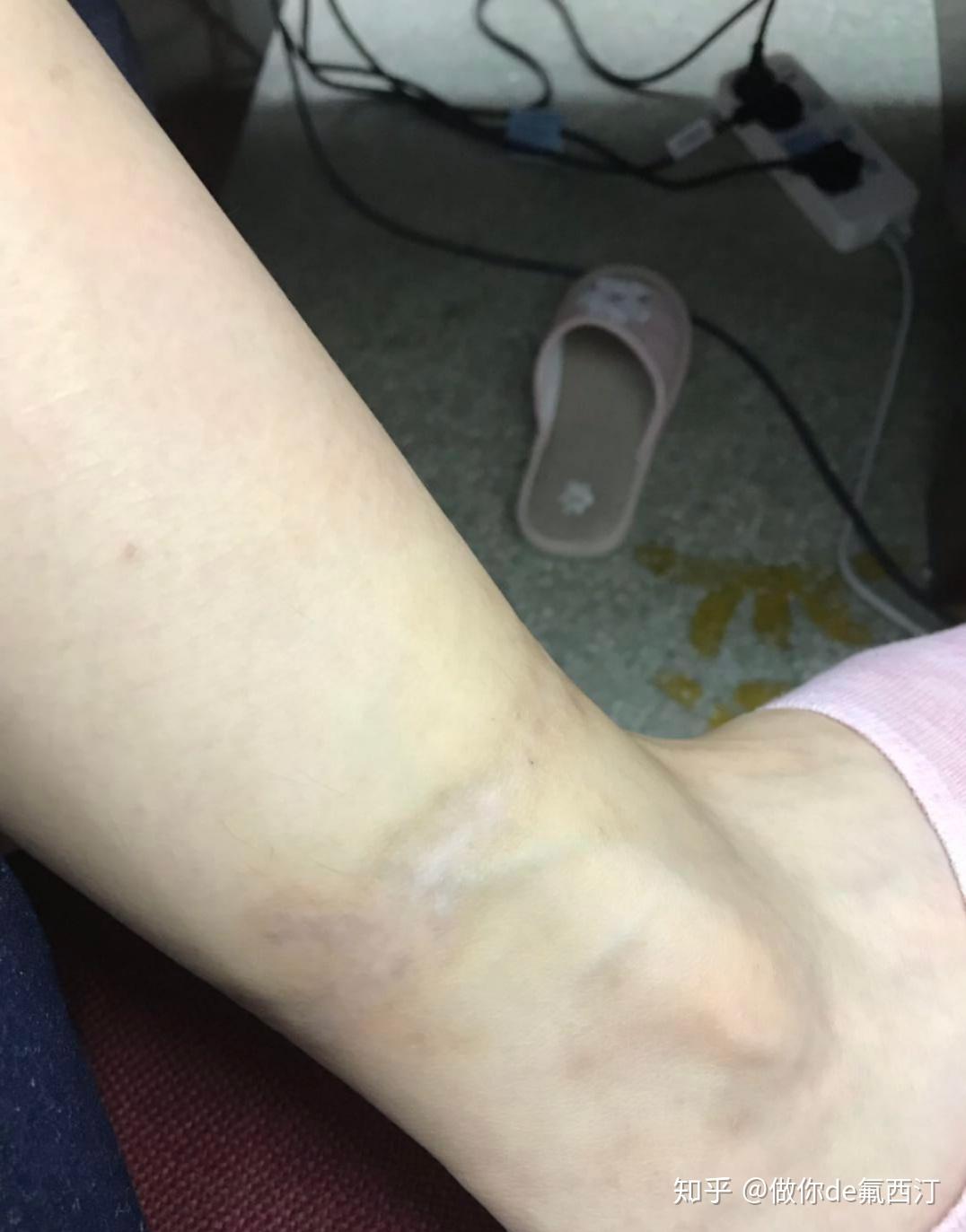 怎样洗纹身不留疤