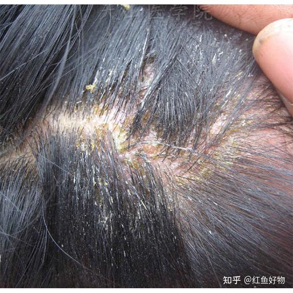 头皮屑多还痒用什么洗发水好?止痒去屑洗发水测评 - 知乎