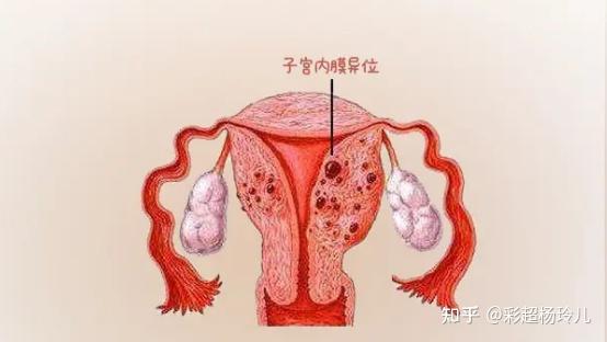 子宫内膜增厚的原因有哪些