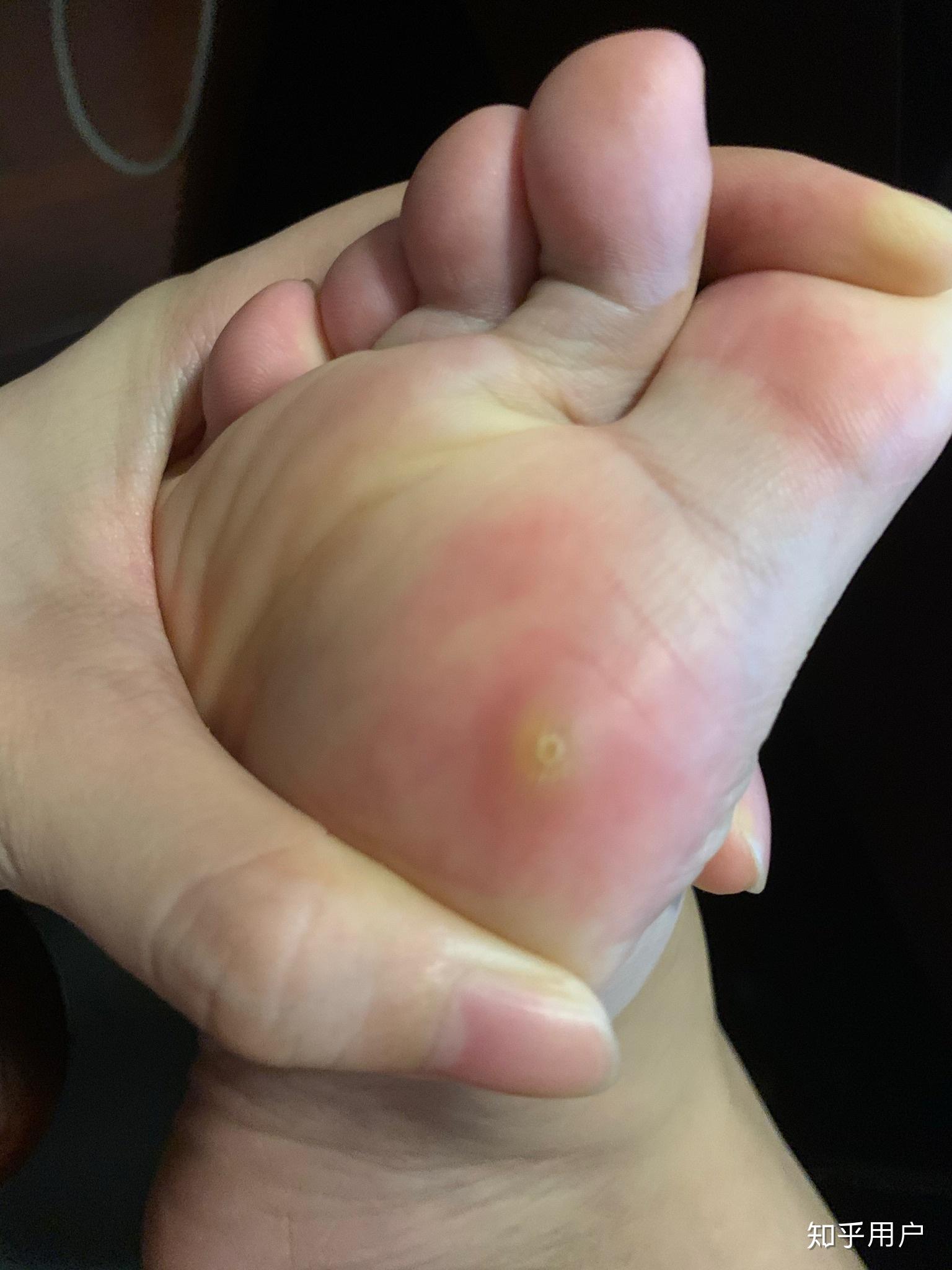 我脚上长了跖疣请问该怎么治疗