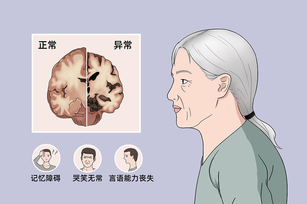 9月21日是世界阿尔茨海默症日患者不仅有中老年人还有三四十岁的青