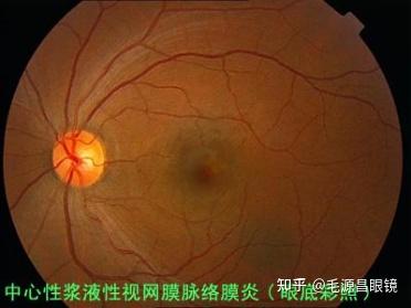影响视觉的常见症状及视力矫正的常见眼病 - 知乎