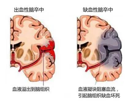 發生腦出血足底放黑血不僅可救命還能把後遺症降到最低靠譜嗎