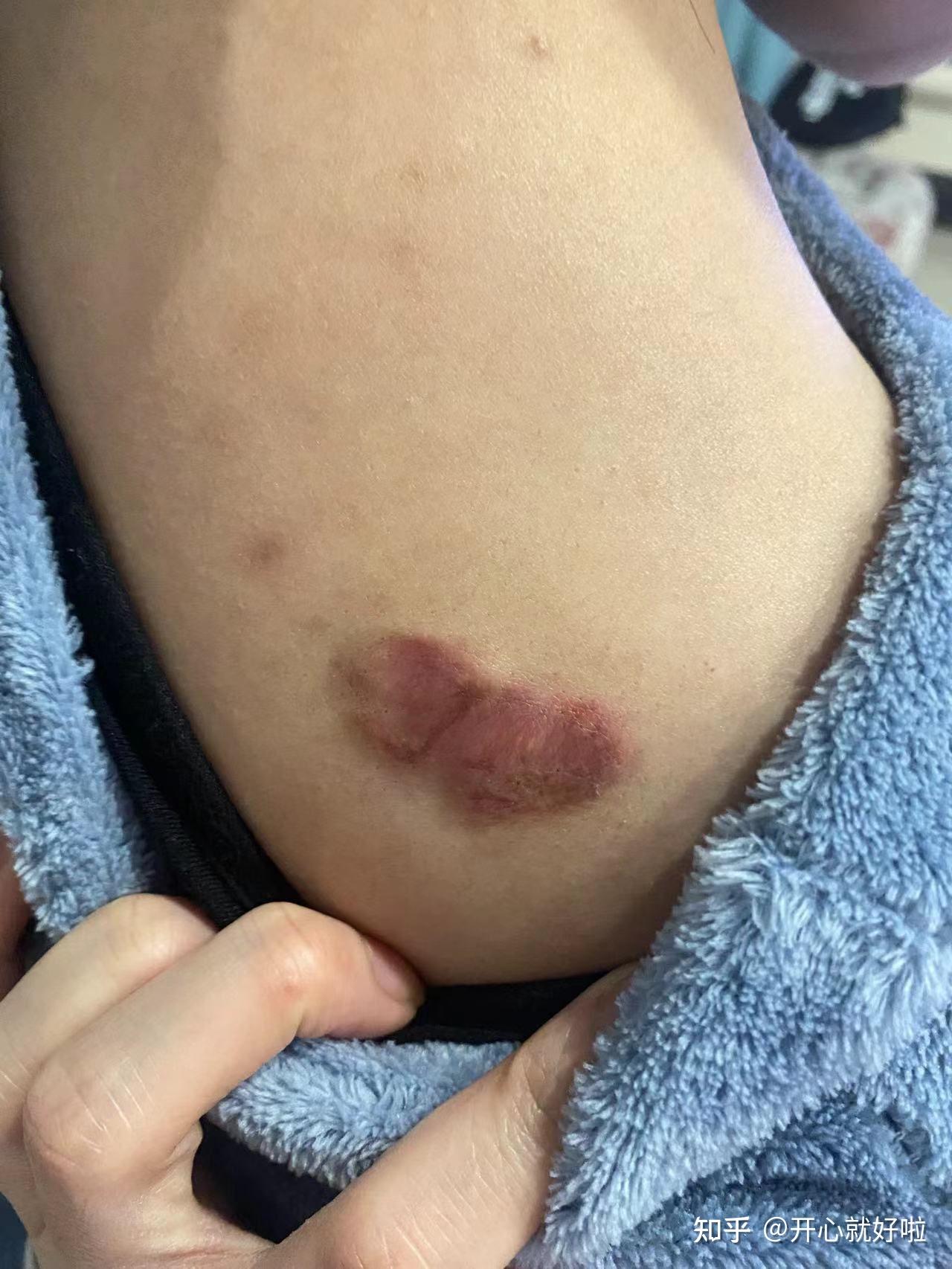 怎么治疗增生性瘢痕疙瘩? - 知乎