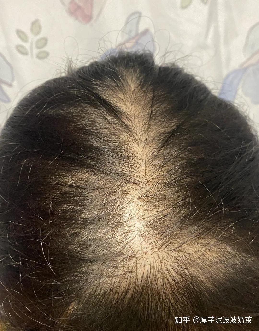 头顶秃了怎么办?