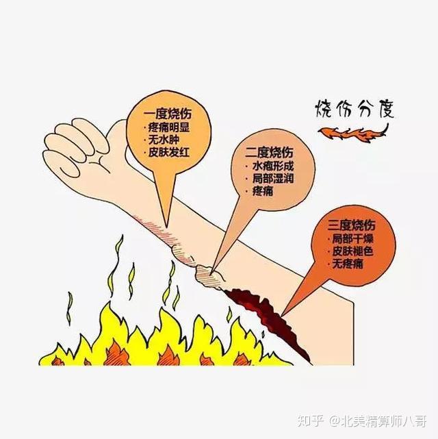 烧烫伤保险怎么赔? - 知乎