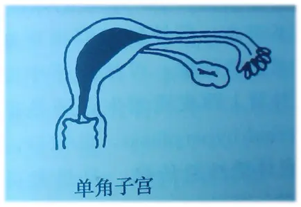 单角子宫能怀孕吗？ - 知乎