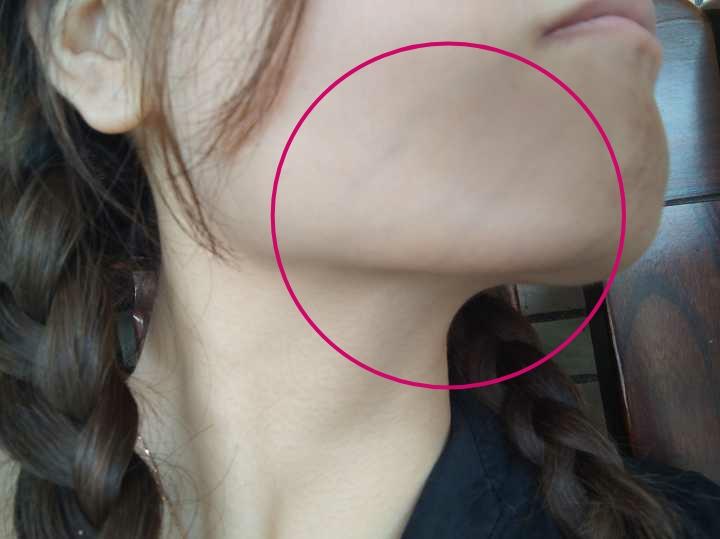从嘴角到两边下巴有明显的青筋血管,这是不是什么预兆有什么办法去除?
