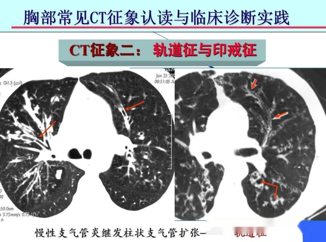 胸部CT读片技巧汇总 - 知乎