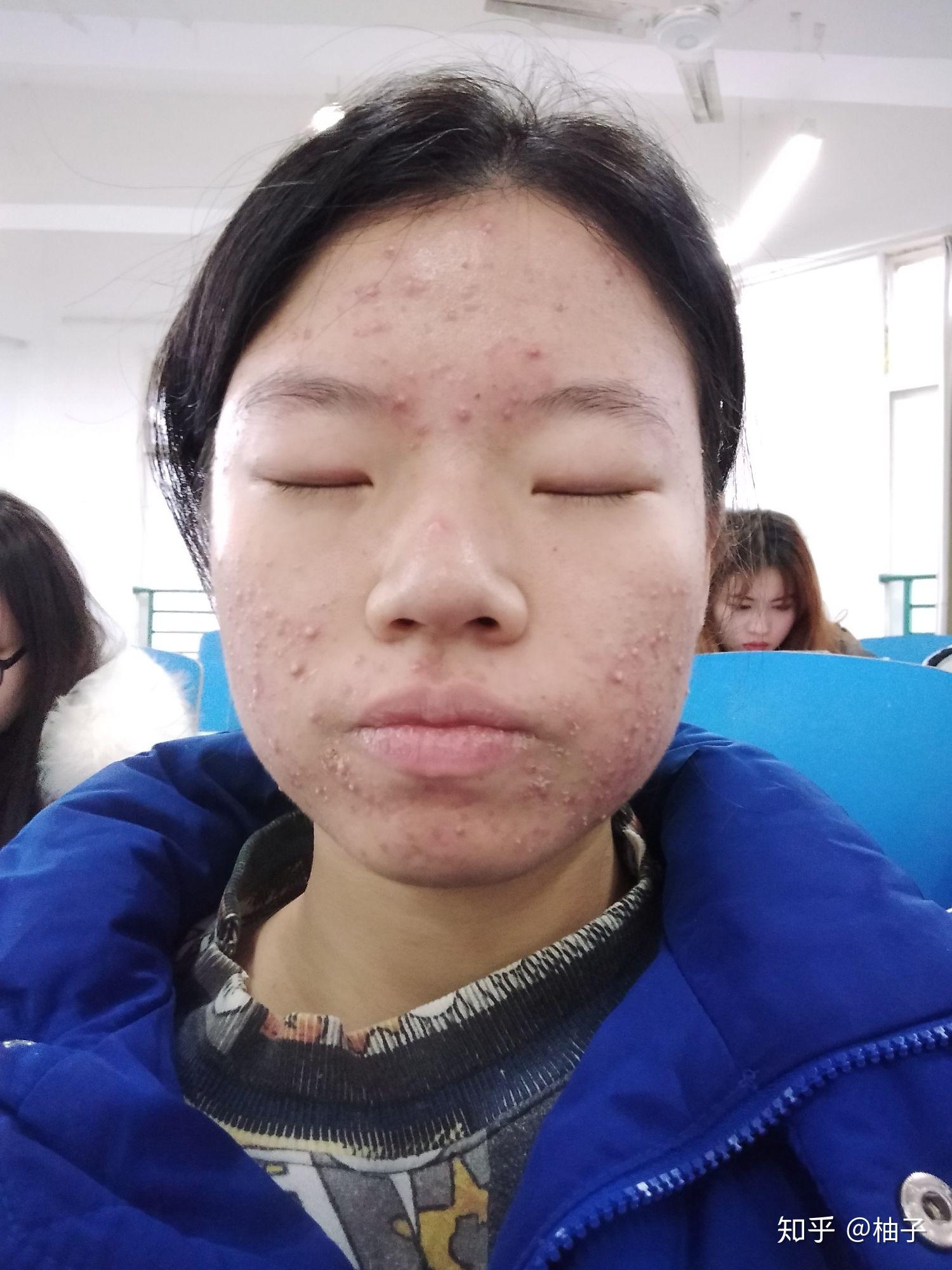 得重度痤疮是种怎样的体验