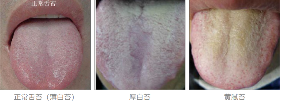 舌苔厚跟舌苔薄的人,到底谁更健康?结果竟然是…… - 知乎