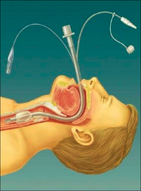 喉咙插管呼吸图片图片
