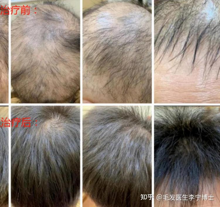 怎么分辨雄性脱发和肾虚型脱发?