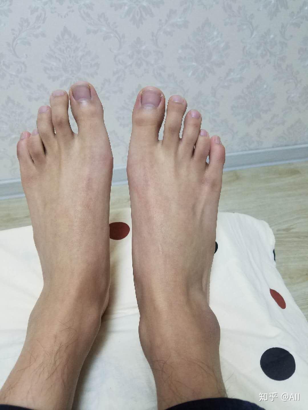 请问有人是第四脚趾短小症吗? - 知乎