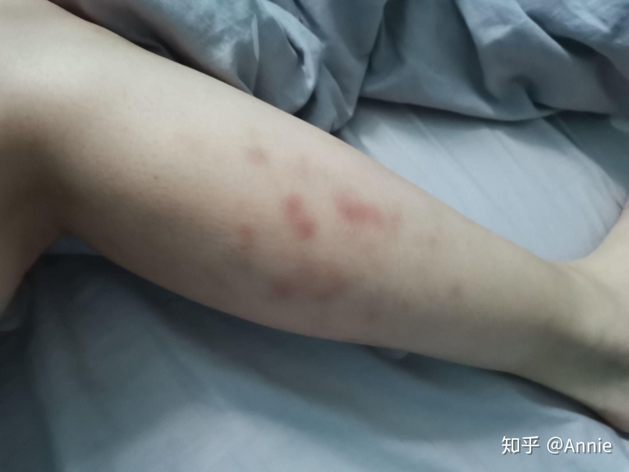 请问使用泡沫轴按摩大腿外侧时出现这样的淤青正常么使用大概半年了