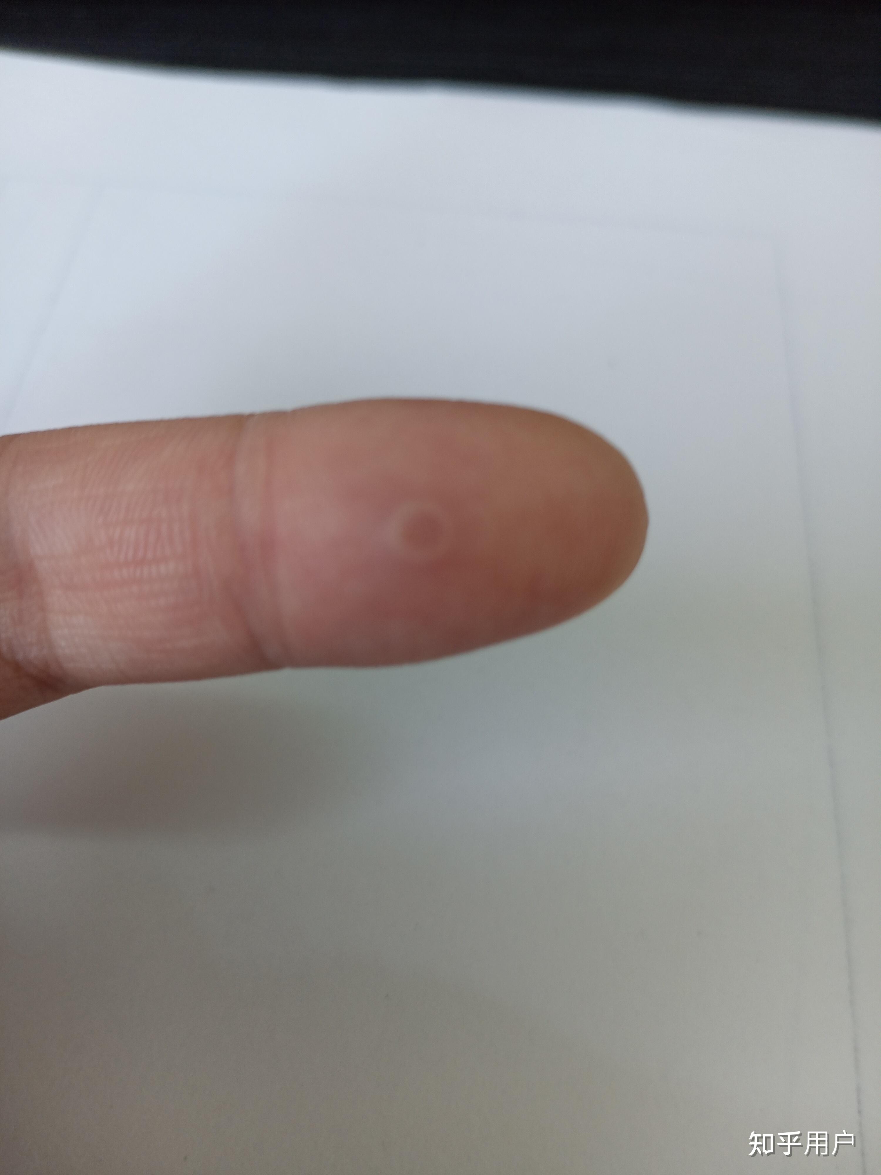 液氮冷冻治疗后手指上出了血泡而且越来越大该怎么办?