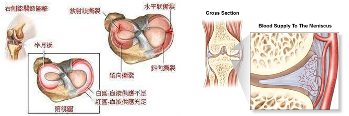 为什么半月板不能自动修复? - 知乎