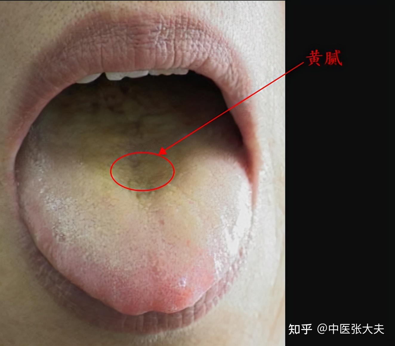 痰湿、寒湿、湿热三者舌苔的区别 - 知乎