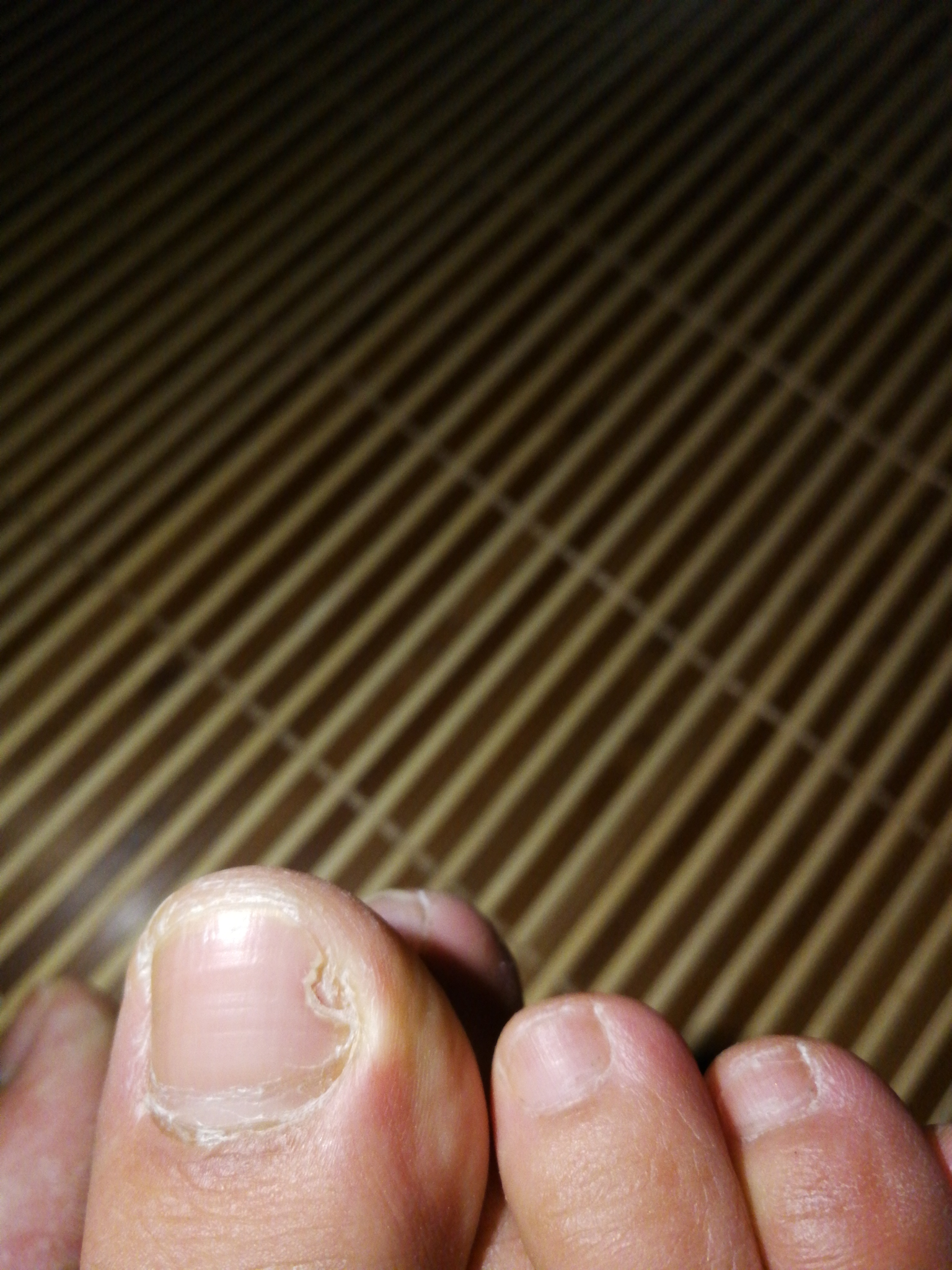 脚趾甲一直这样变空是什么病