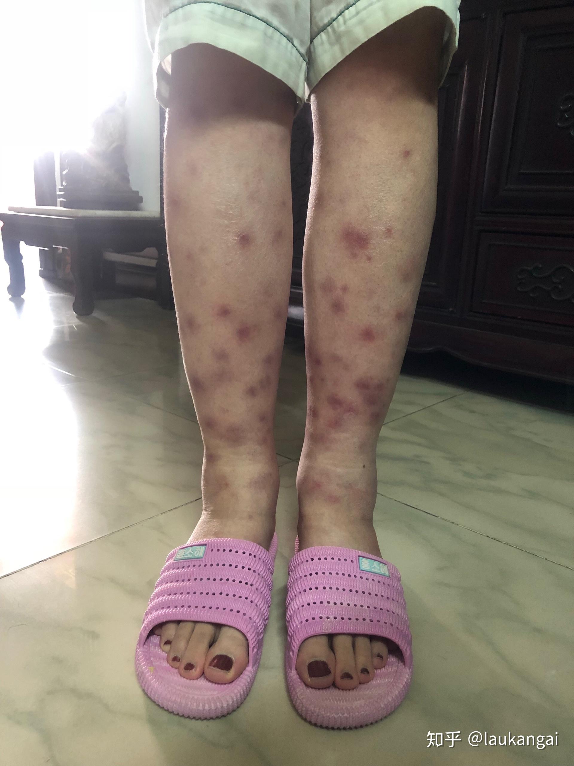 得过结节性红斑的人过来交流下