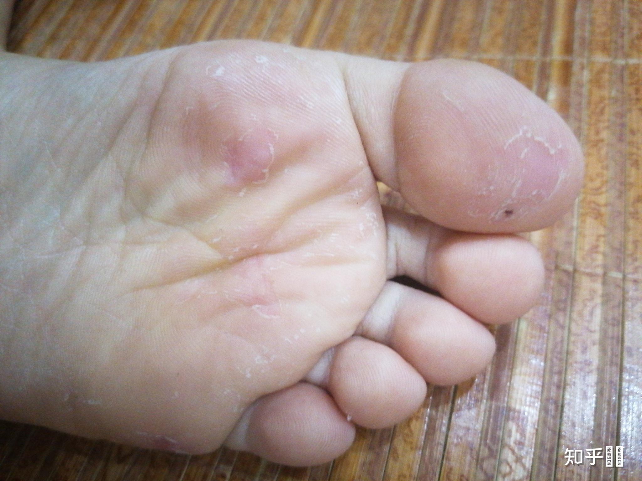 脚老是蜕皮怎么办经常脱皮太难看了如何应对