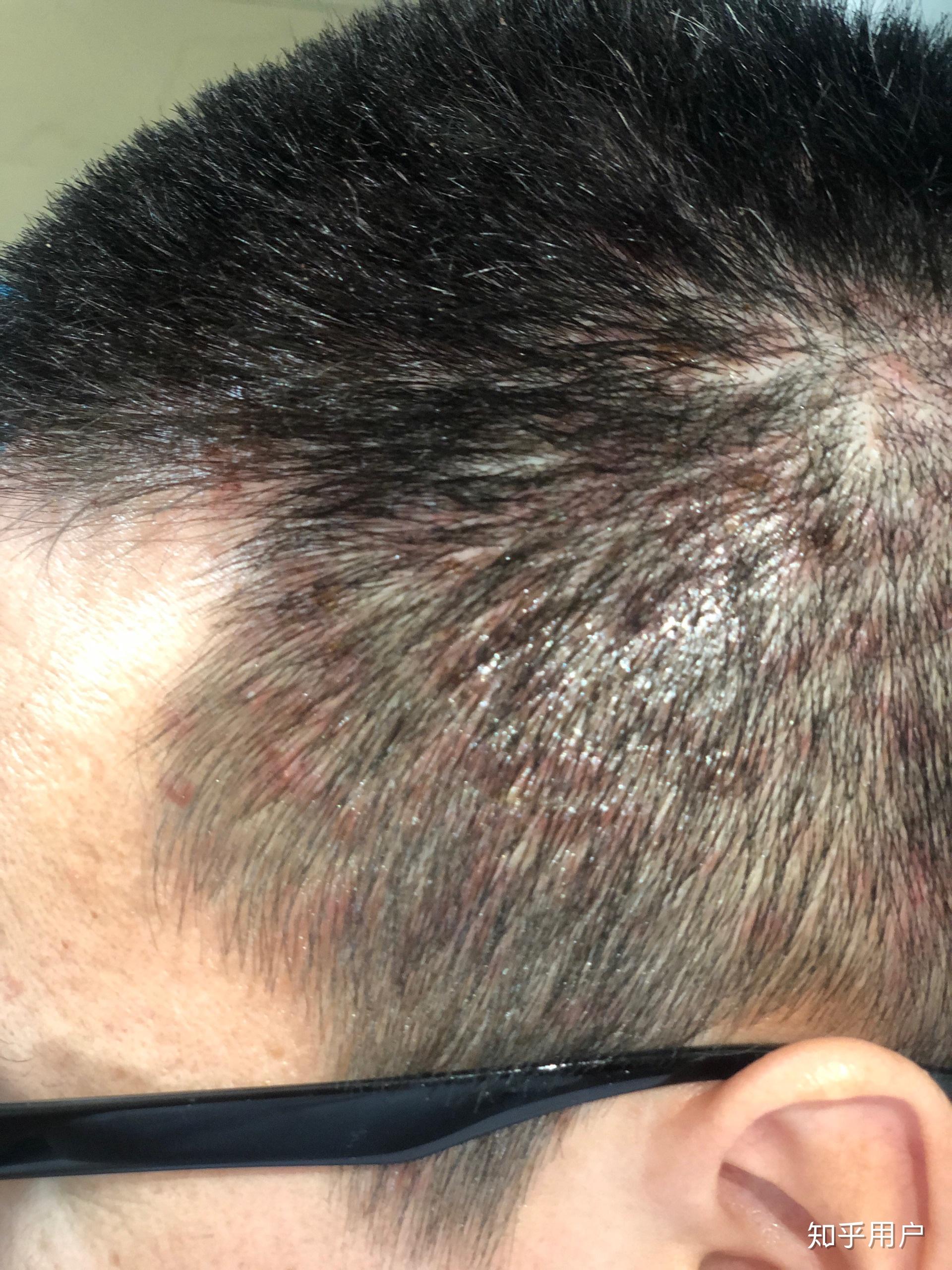 脑袋长一百多个痘痘是什么感受