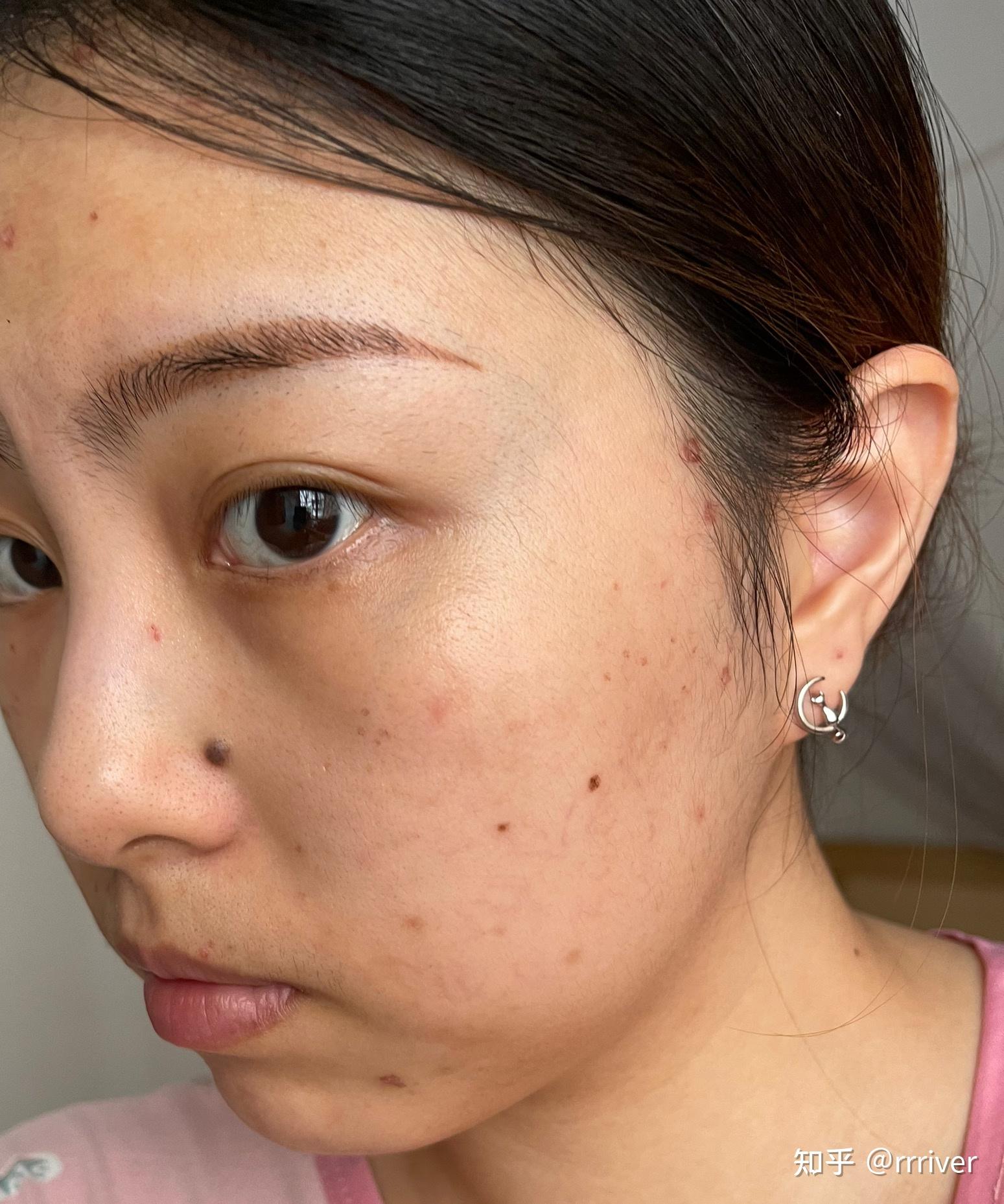 有谁褐青色痣治好过? - 知乎