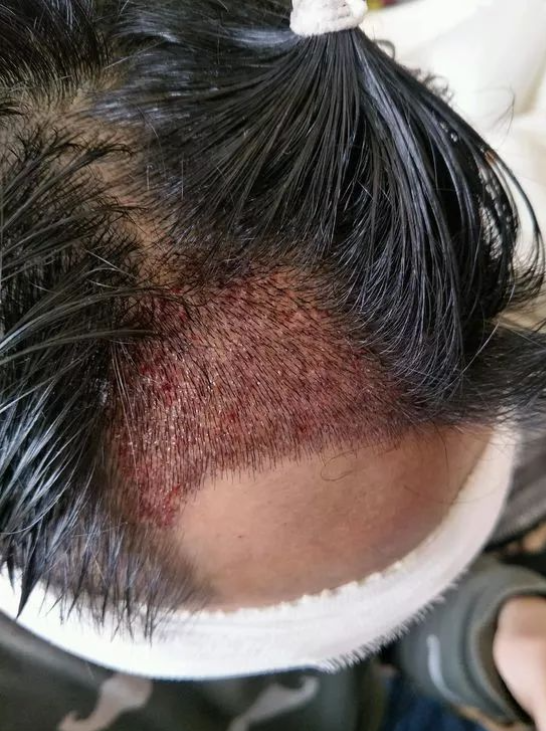 额角脱发3年,终于植发留住了发际线,术后半年效果 - 知乎