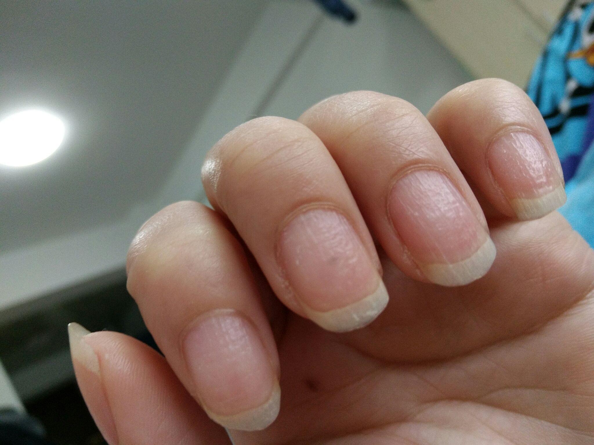 指甲有竖纹究竟是什么原因总体颜色有点偏紫色怎么回事