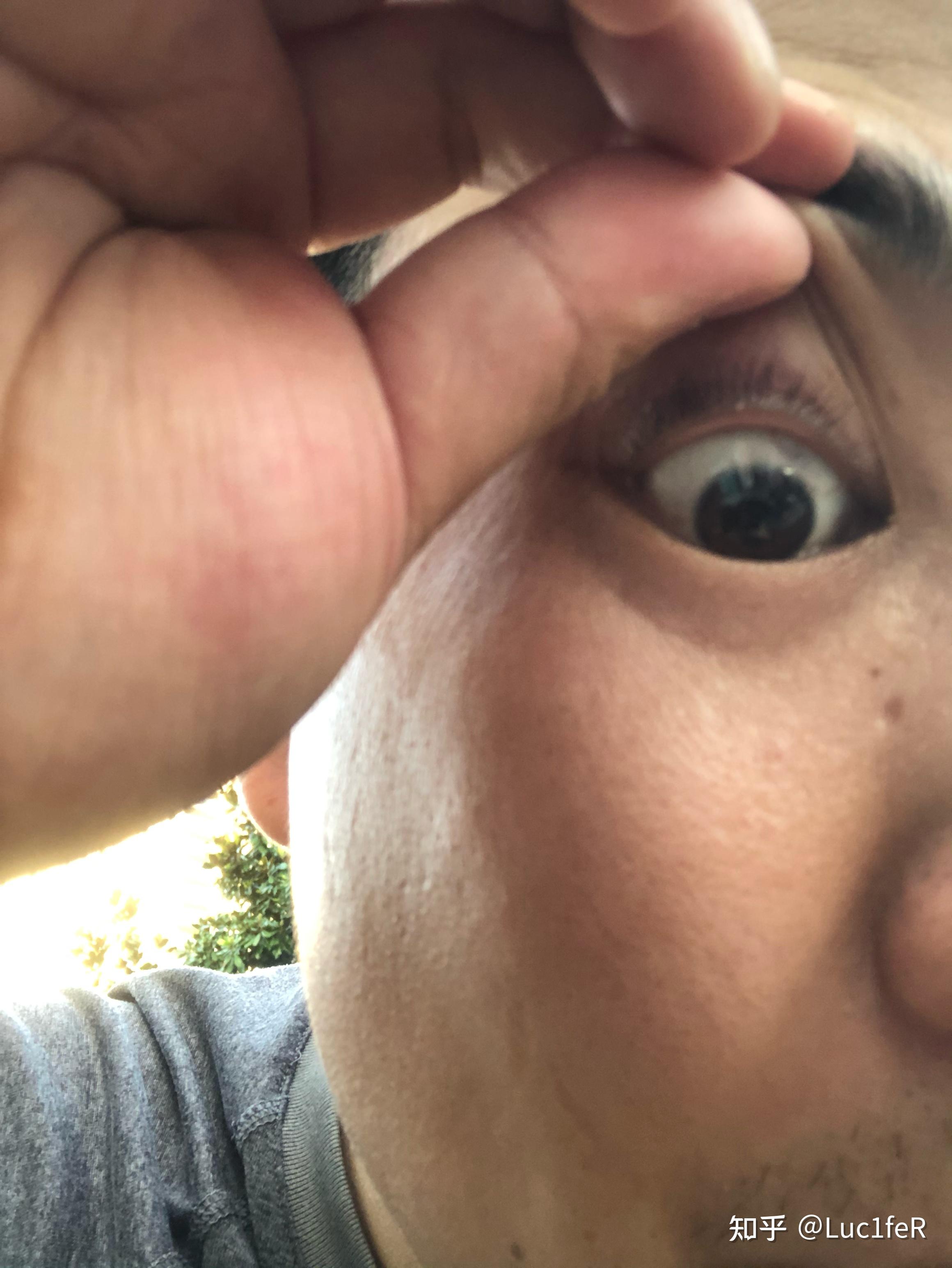 眼皮上长了个白白的小颗粒是脂肪粒吗怎么消掉