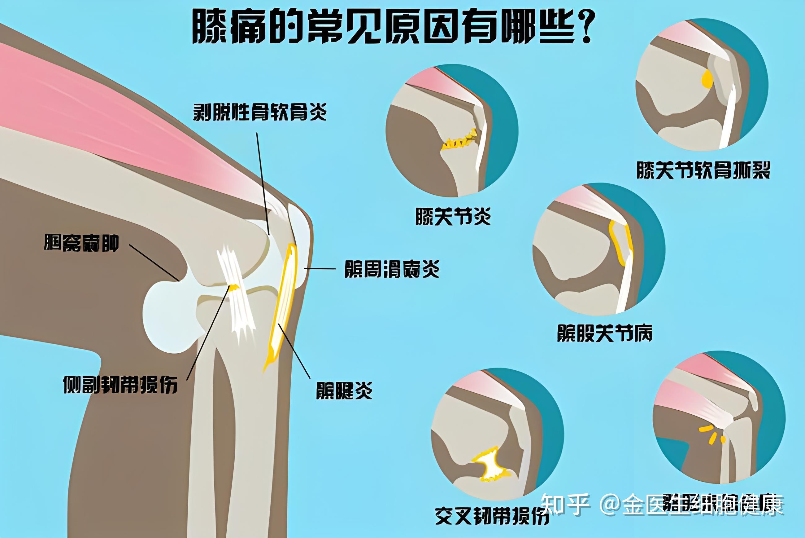 运动过度造成膝盖损伤,关节腔内有积液,髌骨软化,如何恢复?
