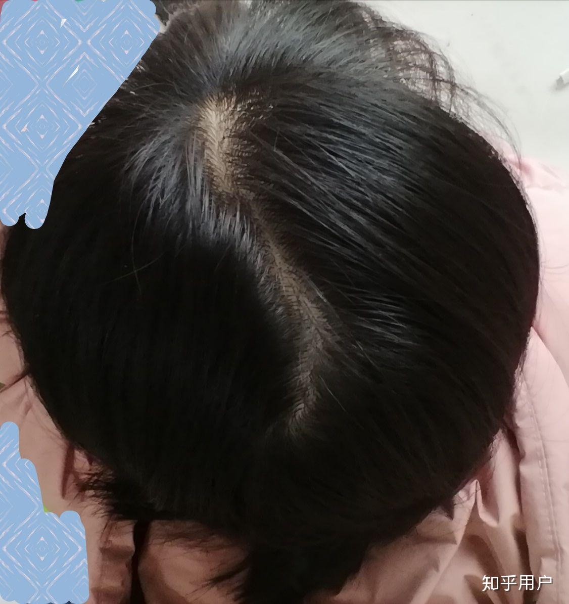 为啥头发缝总是朝这个方向,像秃顶. - 知乎