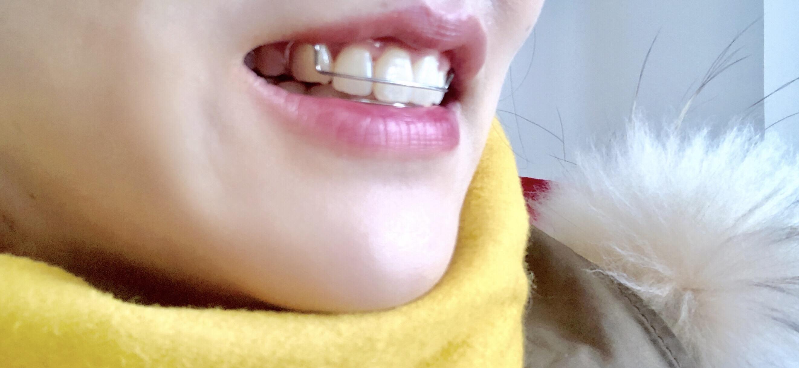 矫正牙齿下牙套后戴牙齿保持器是怎样的体验? - 知乎