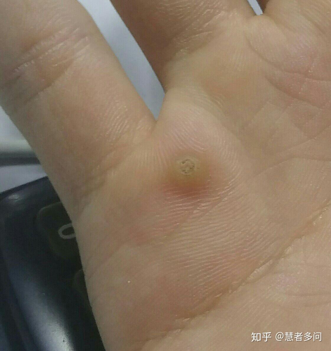 手掌的侧面(左手小拇指一侧)长了个水泡一样的硬泡越来越大