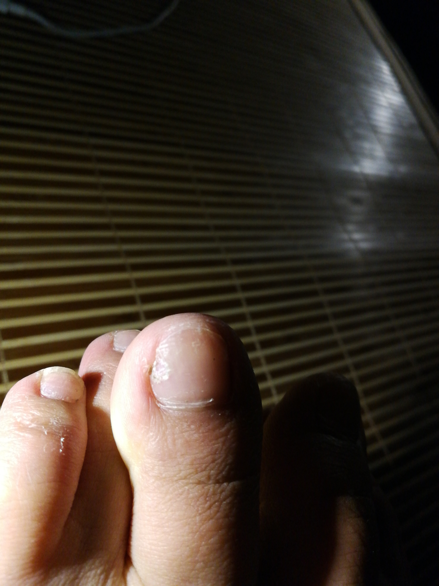 脚趾甲一直这样变空是什么病