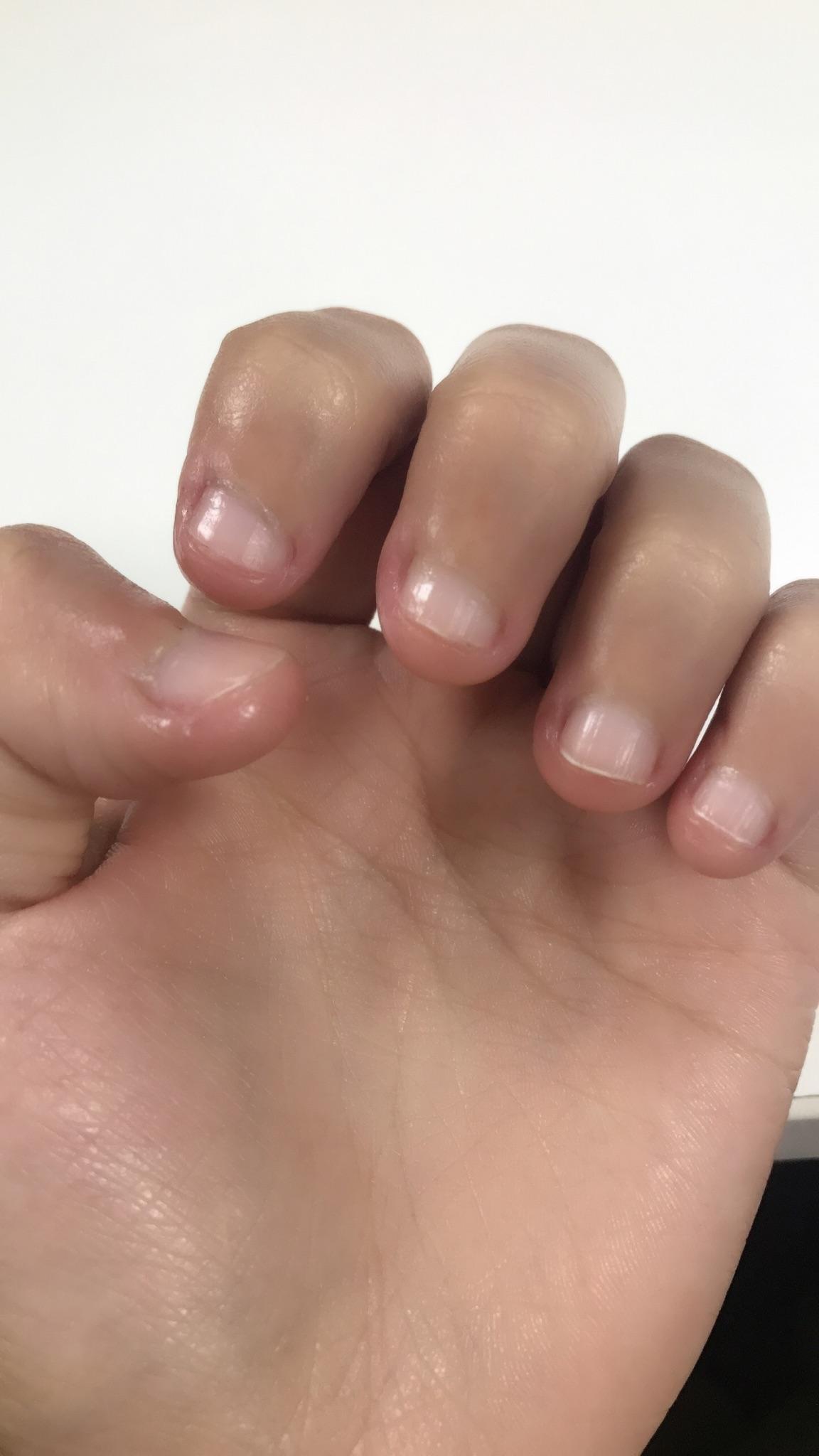 手指甲被咬的超级短怎么办? - 知乎