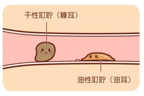 耳屎特别油教你正确护理油耳朵