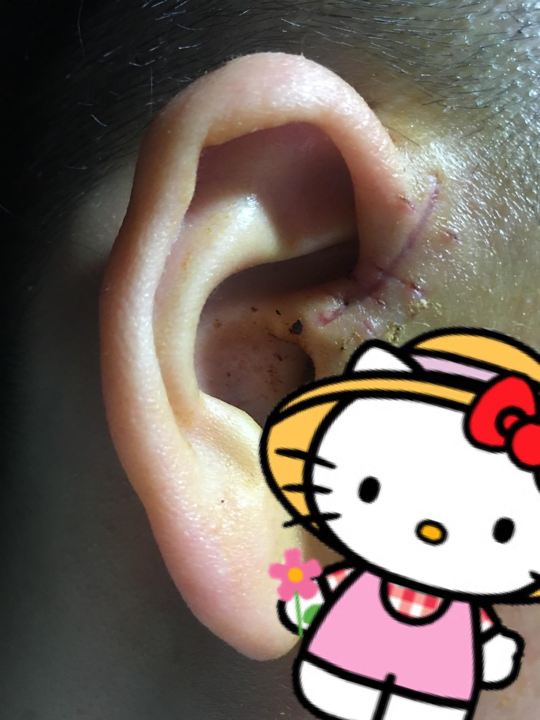 患有先天性耳前瘘管是一种怎样的体验? 