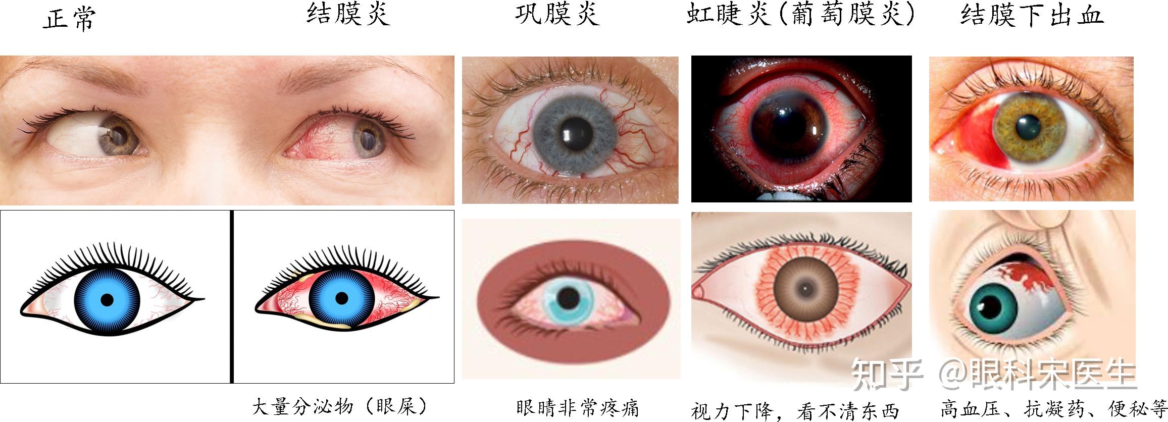 一张图区别常见眼红(结膜炎、巩膜炎、虹睫炎炎、结膜下出血) - 知乎