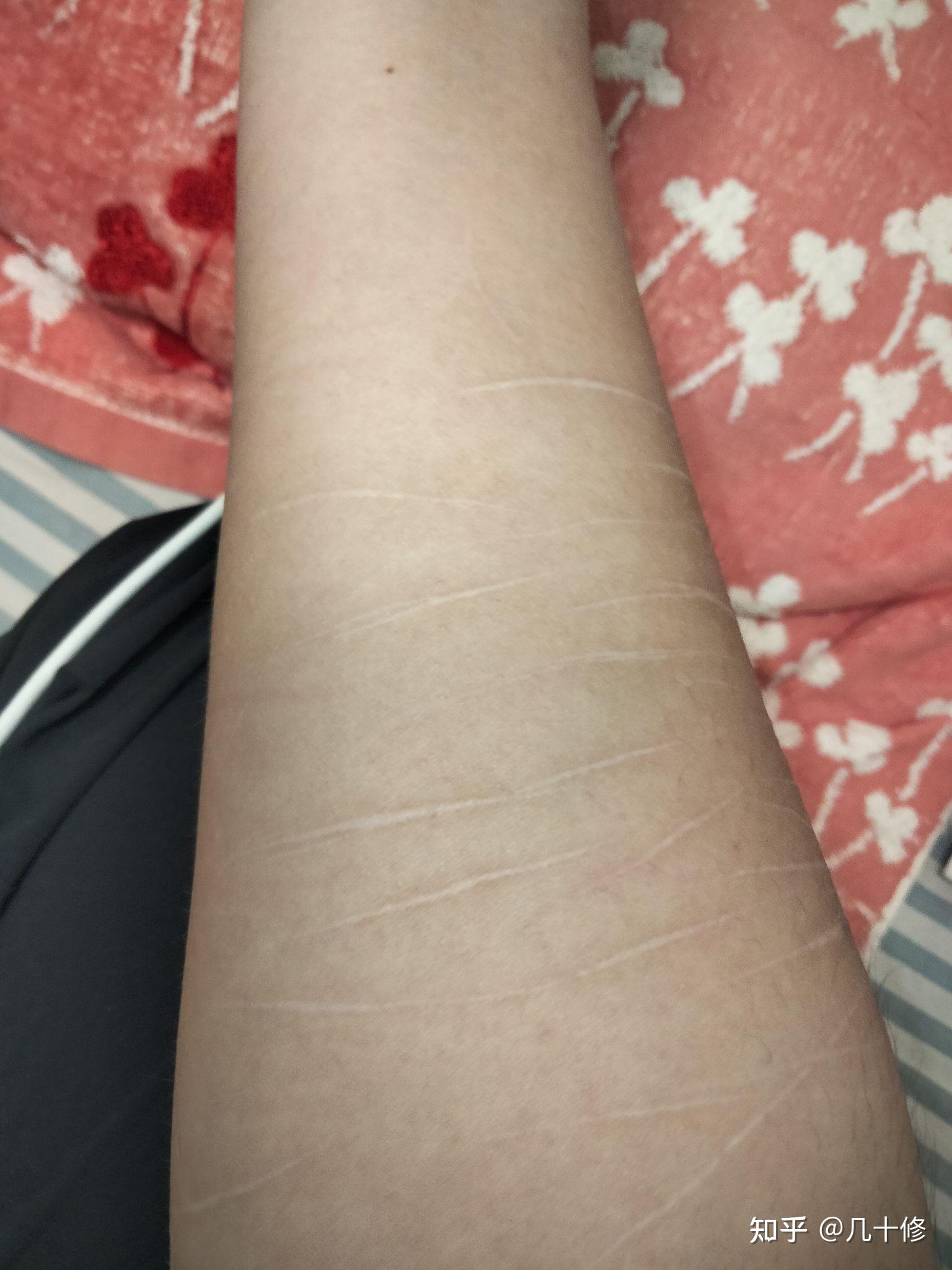 自残过有伤疤的人被看到会被歧视吗?