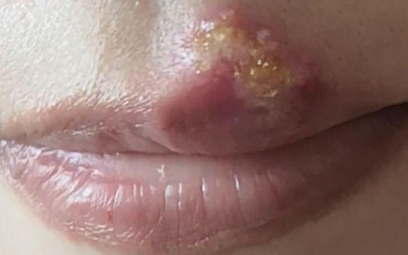 女朋友嘴角涨了疱疹有10年了老是复发有没有啥办法