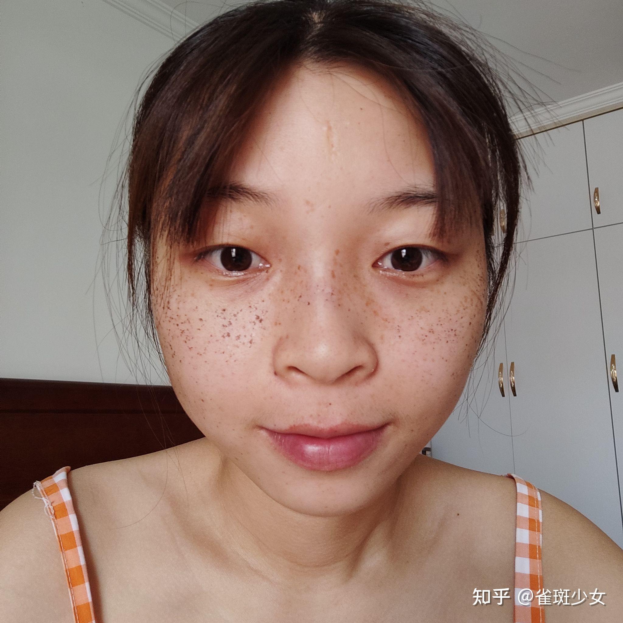 遗传斑怎么去除? - 知乎