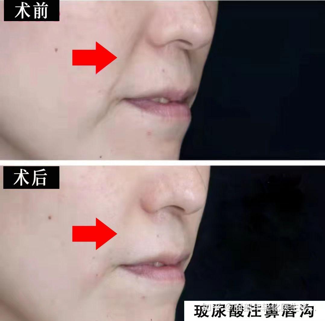 玻尿酸注射鼻唇沟 - 知乎