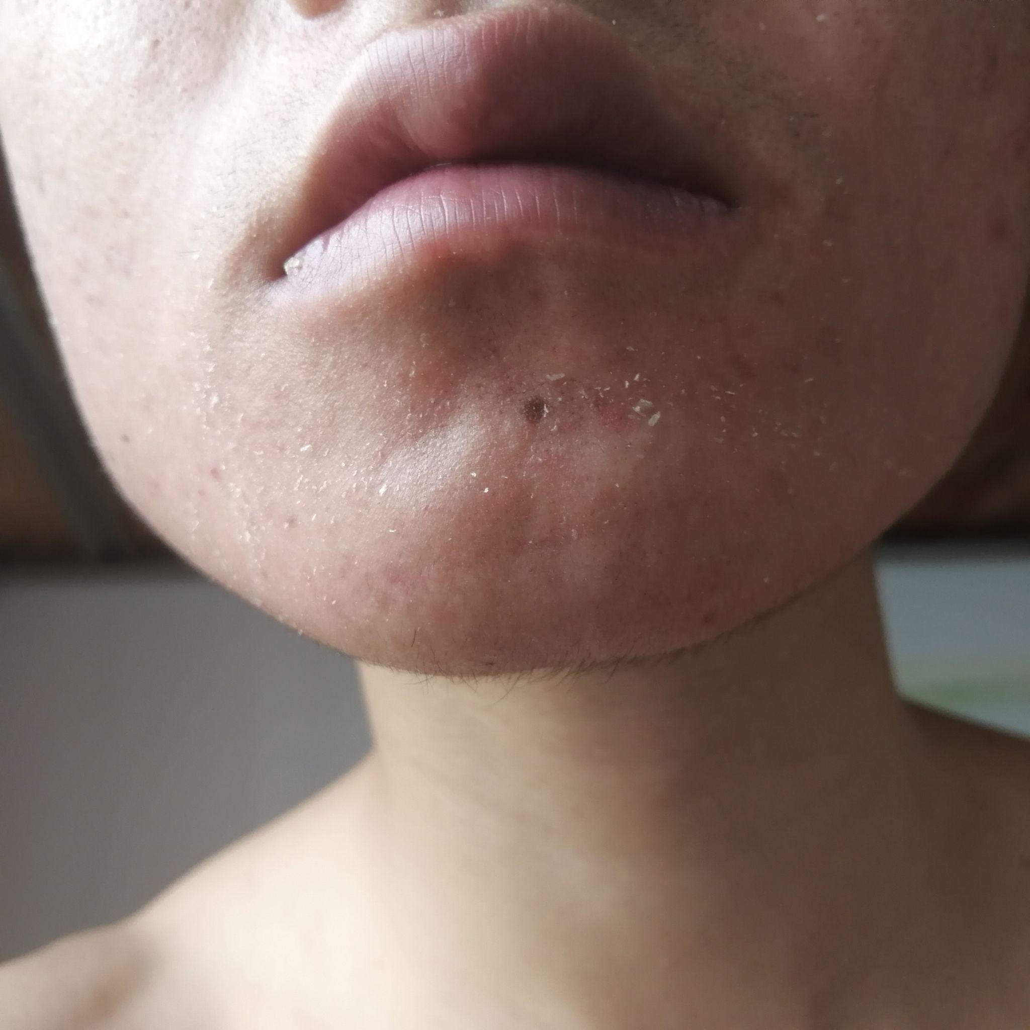 阿达帕林凝胶灼烧蜕皮? - 知乎