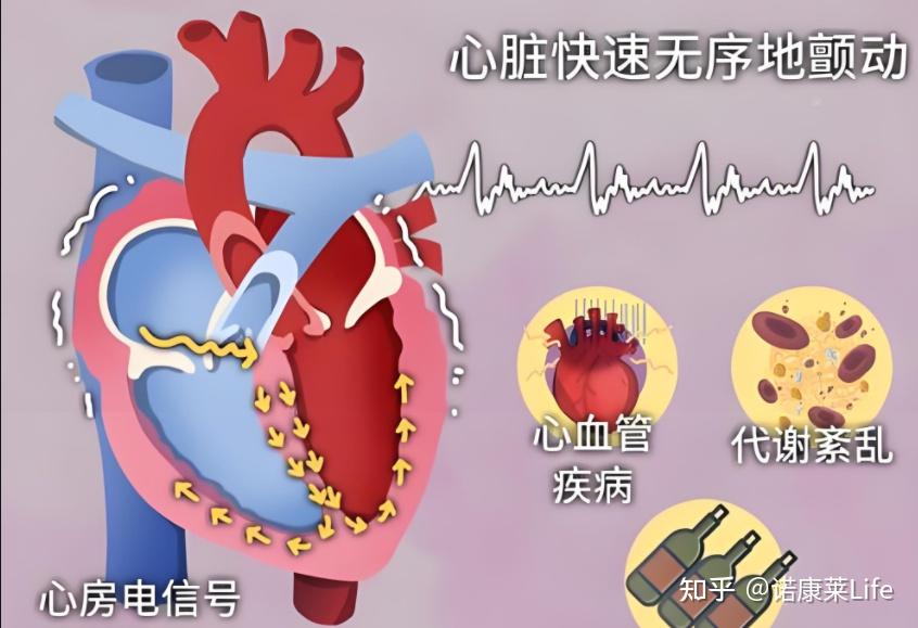 体检上房颤VS室颤有什么区别? - 知乎