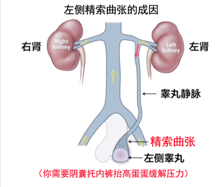 精索静脉曲张导致阴囊下坠睾丸疼痛怎么办? - 知乎
